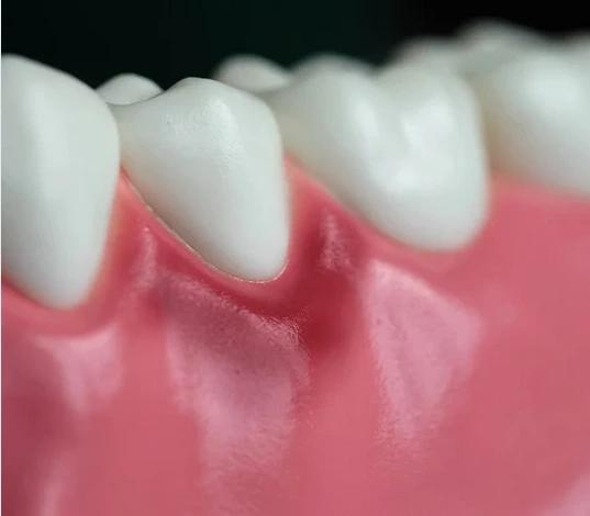 علاج التهاب اللثة للأطفال