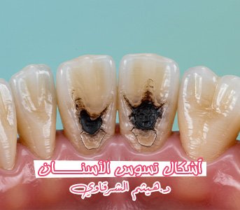 أشكال تسوس الأسنان