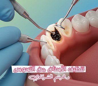 تنظيف الأسنان من التسوس