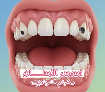 تسوس الأسنان